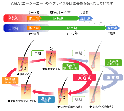 AGAのヘアサイクル